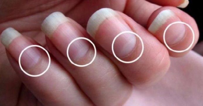 Lunule assenti: cosa rivelano le tue unghie sulla salute
