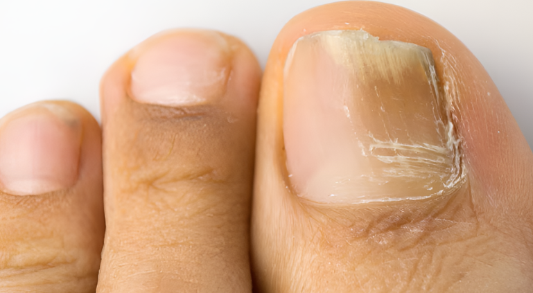 Unghie marroni dopo il pedicure: cause comuni e soluzioni